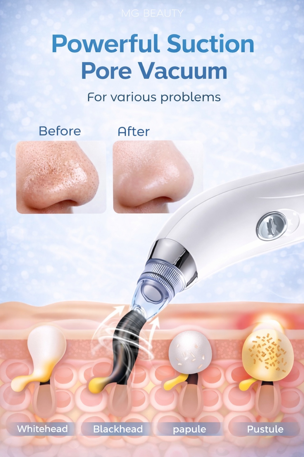Portable Facial Pore Cleaner